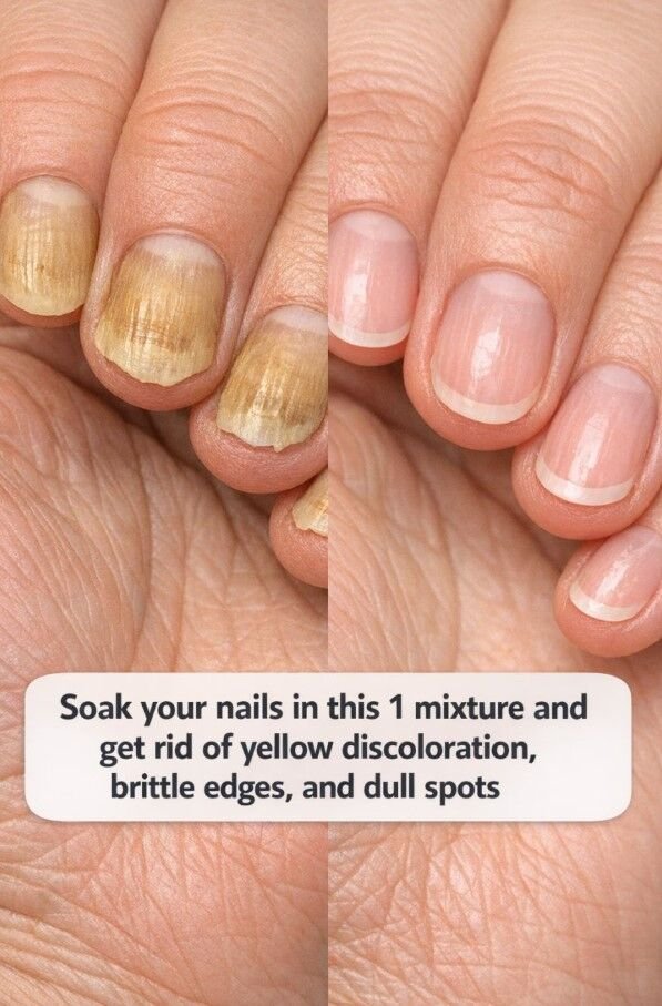 Soak your nails in this 1 mixture and get rid of yellow discoloration, brittle edges, and dull spots