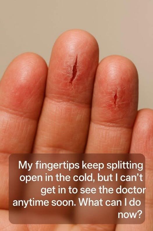 My Fingertips Keep Splitting Open in the Cold — What You Can Do Right Now to Heal and Prevent It