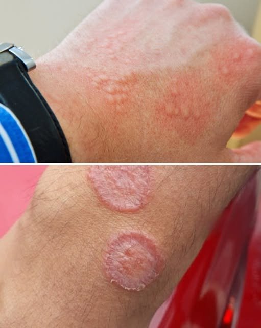 Signs of Groin Skin Irritation and How to Address Them